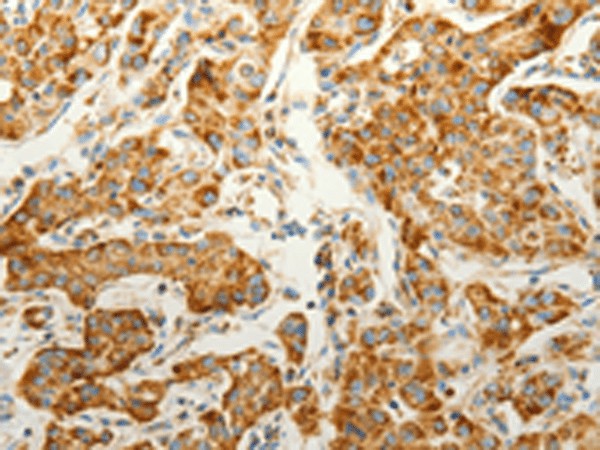 Immunohistochemistry of paraffin-embedded Human lung cancer tissue  using VDAC2 Polyclonal Antibody at dilution of 1:25(?200)