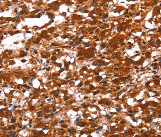 Immunohistochemistry of paraffin-embedded Human thyroid cancer using FUT1 Polyclonal Antibody at dilution of 1:30