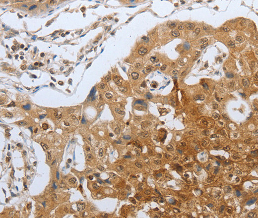 Immunohistochemistry of paraffin-embedded Human lung cancer using CASP12 Polyclonal Antibody at dilution of 1:50