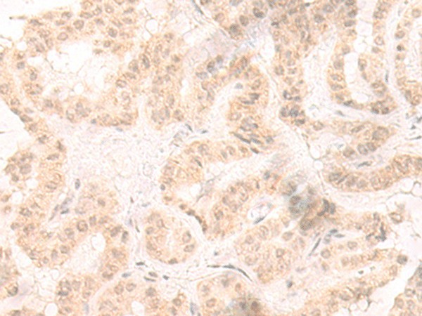 Immunohistochemistry of paraffin-embedded Human thyroid cancer tissue  using IL33 Polyclonal Antibody at dilution of 1:25(?200)