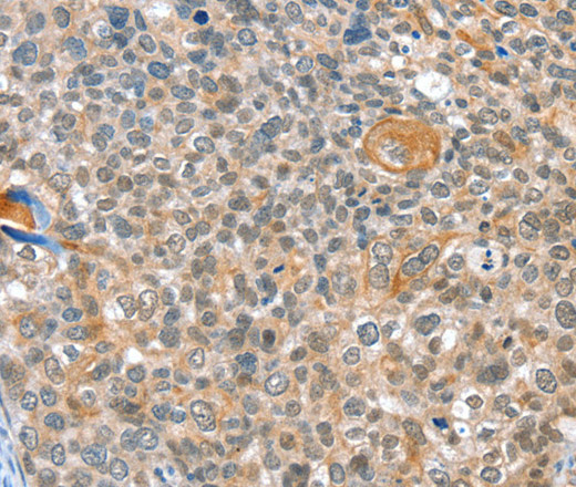 Immunohistochemistry of paraffin-embedded Human cervical cancer using ALDOB Polyclonal Antibody at dilution of 1:40