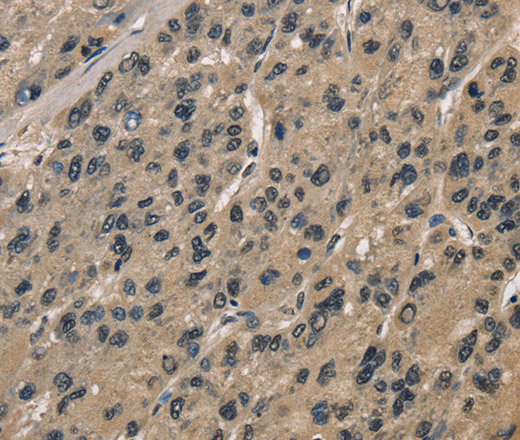 Immunohistochemistry of paraffin-embedded Human liver cancer tissue using CCAR1 Polyclonal Antibody at dilution 1:40