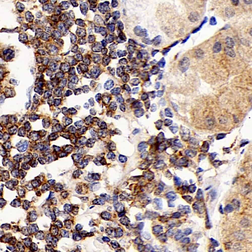 Immunohistochemistry analysis of paraffin-embedded human stomach cancer  using CD192 Polyclonal Antibody at dilution of 1:300.