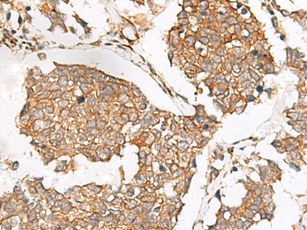 Immunohistochemistry of paraffin-embedded Human lung cancer tissue  using SLC40A1 Polyclonal Antibody at dilution of 1:65(?200)