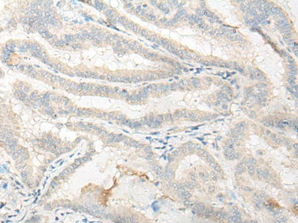 Immunohistochemistry of paraffin-embedded Human thyroid cancer tissue  using DNASE1L1 Polyclonal Antibody at dilution of 1:25(?200)