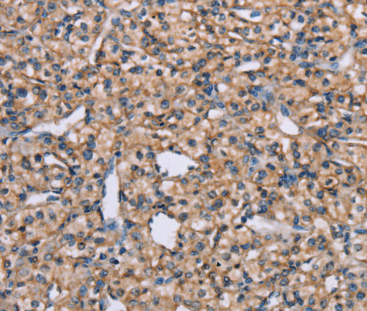 Immunohistochemistry of paraffin-embedded Human prostate cancer tissue using ADAM29 Polyclonal Antibody at dilution 1:40