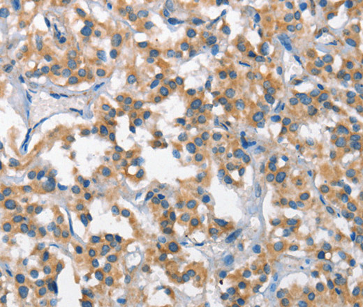 Immunohistochemistry of paraffin-embedded Human thyroid cancer tissue using SCARB1 Polyclonal Antibody at dilution 1:65