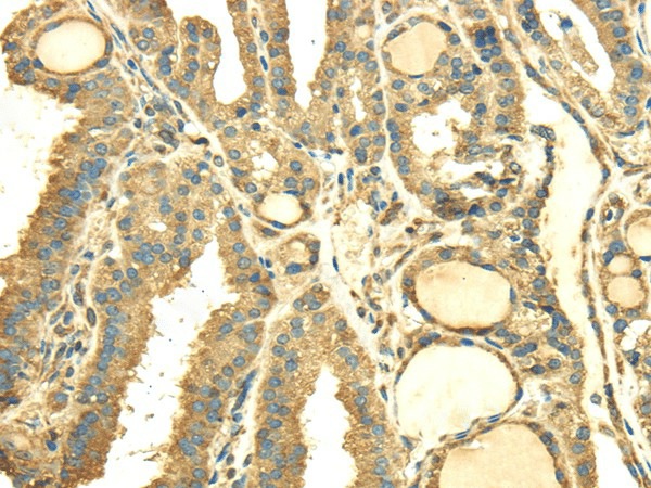 Immunohistochemistry of paraffin-embedded Human thyroid cancer tissue using SDF4 Polyclonal Antibody at dilution 1:40