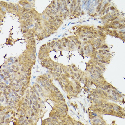 Immunohistochemistry of paraffin-embedded human colon carcinoma using PSMA3 Polyclonal Antibody at dilution of 1:100 (40x lens).Perform high pressure antigen retrieval with 10 mM citrate buffer pH 6.0 before commencing with IHC staining protocol.