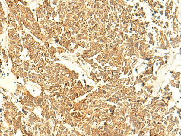 Immunohistochemistry of paraffin-embedded Human lung cancer tissue  using UNKL Polyclonal Antibody at dilution of 1:50(?200)