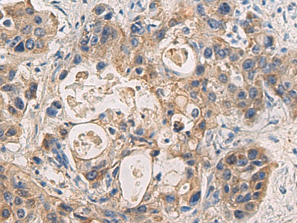 Immunohistochemistry of paraffin-embedded Human liver cancer tissue  using DMRTA2 Polyclonal Antibody at dilution of 1:50(?200)