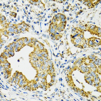 Immunohistochemistry of paraffin-embedded Human gastric cancer using HSPA9 Polyclonal Antibody at dilution of 1:100 (40x lens).