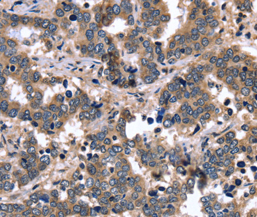 Immunohistochemistry of paraffin-embedded Human liver cancer tissue using FGFR1OP2 Polyclonal Antibody at dilution 1:40