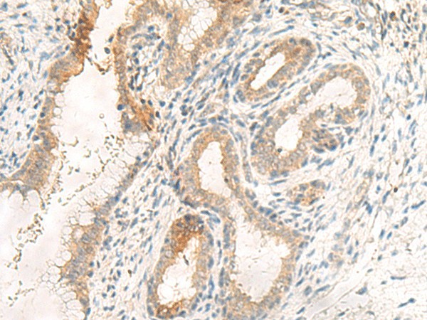 Immunohistochemistry of paraffin-embedded Human cervical cancer tissue  using GPR89A/GPR89B Polyclonal Antibody at dilution of 1:25(?200)