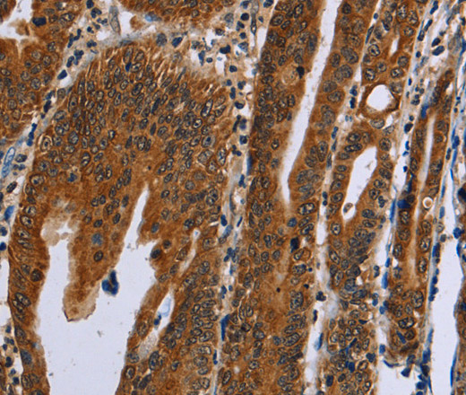 Immunohistochemistry of paraffin-embedded Human gastric cancer using GH2 Polyclonal Antibody at dilution of 1:60