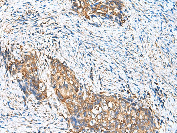 Immunohistochemistry of paraffin-embedded Human cervical cancer tissue  using CAMSAP3 Polyclonal Antibody at dilution of 1:110(?200)