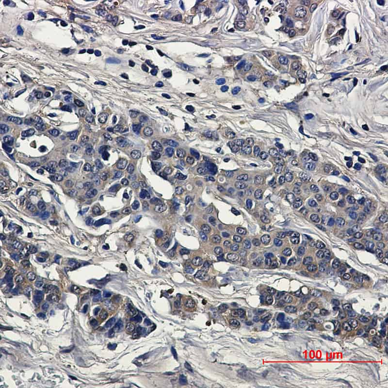 Immunohistochemical of Superoxide Dismutase 1 in Human breast cancer tissue using Superoxide Dismutase 1 antibody at dilution 1:50