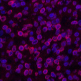 Immunofluorescence analysis of Human lung cancer tissue using Lamin B1 Monoclonal Antibody at dilution of 1:200.