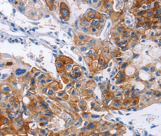 Immunohistochemistry of paraffin-embedded Human lung cancer using CD54 Polyclonal Antibody at dilution of 1:30