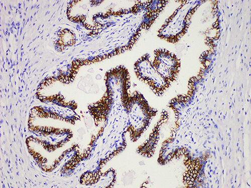 Immunohistochemistry of paraffinembedded Human prostate cancer tissue with Prostatic Acid Phosphatase(PSAP) Monoclonal Antibody(Antigen repaired by EDTA).