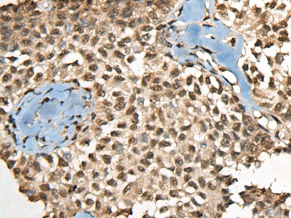 Immunohistochemistry of paraffin-embedded Human ovarian cancer tissue  using CCDC12 Polyclonal Antibody at dilution of 1:60(?200)