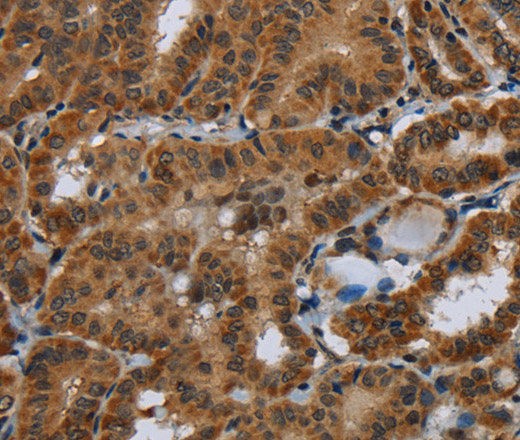 Immunohistochemistry of paraffin-embedded Human thyroid cancer tissue using Glucocorticoid Receptor Polyclonal Antibody at dilution 1:40