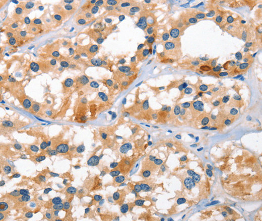 Immunohistochemistry of paraffin-embedded Human thyroid cancer tissue using BNIP3L Polyclonal Antibody at dilution 1:40