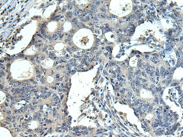 Immunohistochemistry of paraffin-embedded Human colorectal cancer tissue  using FCRLA Polyclonal Antibody at dilution of 1:90(?200)