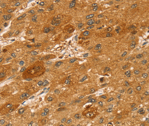 Immunohistochemistry of paraffin-embedded Human liver cancer tissue using STX2 Polyclonal Antibody at dilution 1:50