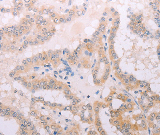 Immunohistochemistry of paraffin-embedded Human thyroid cancer tissue using TPO Polyclonal Antibody at dilution 1:50