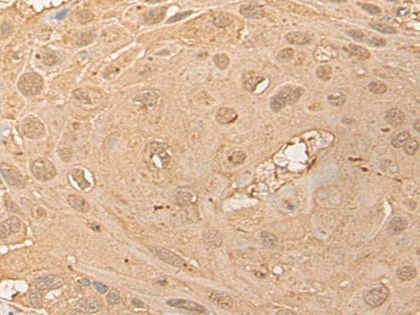 Immunohistochemistry of paraffin-embedded Human esophagus cancer tissue  using CPNE3 Polyclonal Antibody at dilution of 1:40(?200)