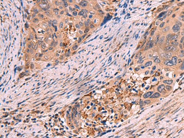 Immunohistochemistry of paraffin-embedded Human cervical cancer tissue  using SHC4 Polyclonal Antibody at dilution of 1:85(?200)