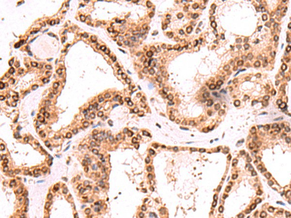 Immunohistochemistry of paraffin-embedded Human thyroid cancer tissue  using TOR1AIP1 Polyclonal Antibody at dilution of 1:60(?200)