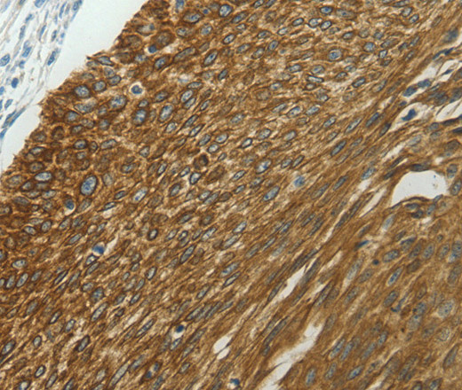 Immunohistochemistry of paraffin-embedded Human cervical cancer tissue using NDRG2 Polyclonal Antibody at dilution 1:40