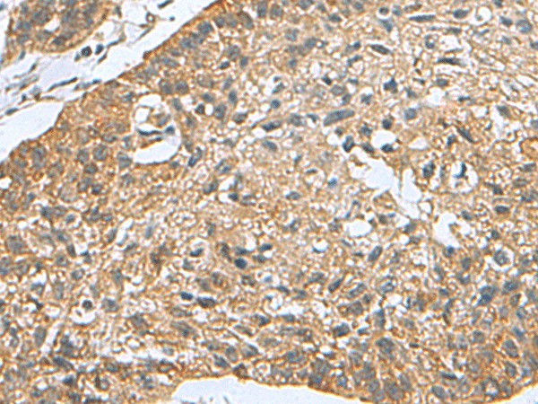 Immunohistochemistry of paraffin-embedded Human esophagus cancer tissue  using PDCD5 Polyclonal Antibody at dilution of 1:105(?200)