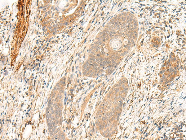 Immunohistochemistry of paraffin-embedded Human esophagus cancer tissue  using FLNC Polyclonal Antibody at dilution of 1:35(?200)