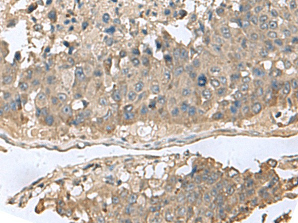 Immunohistochemistry of paraffin-embedded Human liver cancer tissue  using GABARAPL2 Polyclonal Antibody at dilution of 1:60(?200)