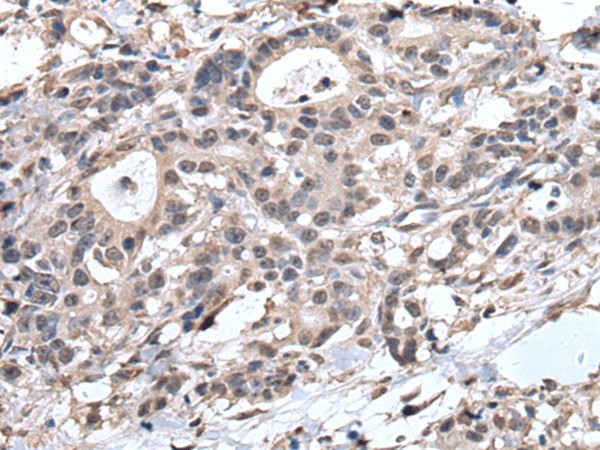 Immunohistochemistry of paraffin-embedded Human gastric cancer tissue  using TRIM27 Polyclonal Antibody at dilution of 1:65(?200)