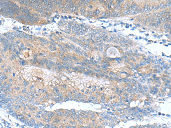 Immunohistochemistry of paraffin-embedded Human colorectal cancer tissue  using JOSD1 Polyclonal Antibody at dilution of 1:90(?200)