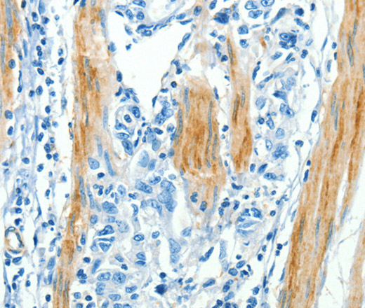 Immunohistochemistry of paraffin-embedded Human gastic cancer using CAV3 Polyclonal Antibody at dilution of 1:30