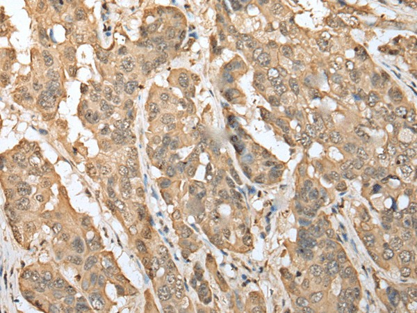 Immunohistochemistry of paraffin-embedded Human breast cancer tissue  using ZNF672 Polyclonal Antibody at dilution of 1:30(?200)