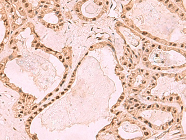 Immunohistochemistry of paraffin-embedded Human thyroid cancer tissue  using SETDB1 Polyclonal Antibody at dilution of 1:60(?200)