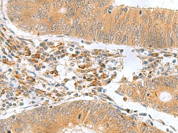 Immunohistochemistry of paraffin-embedded Human colorectal cancer tissue  using MYDGF Polyclonal Antibody at dilution of 1:65(?200)