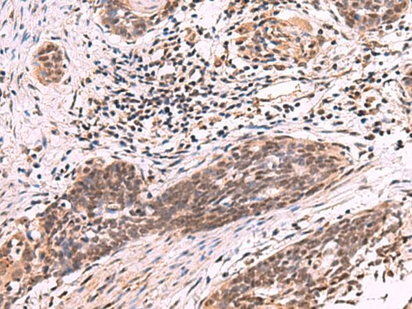 Immunohistochemistry of paraffin-embedded Human esophagus cancer tissue  using ARIH2 Polyclonal Antibody at dilution of 1:80(?200)