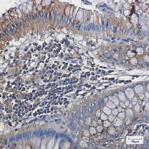 Immunohistochemistry of VEGF Receptor 1 in paraffin-embedded Human colon cancer tissue using VEGF Receptor 1 Rabbit mAb at dilution 1:50