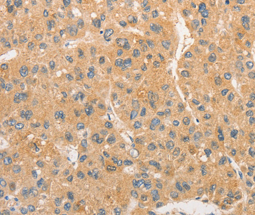 Immunohistochemistry of paraffin-embedded Human liver cancer tissue using TLR3 Polyclonal Antibody at dilution 1:40