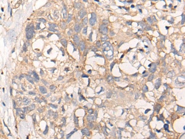 Immunohistochemistry of paraffin-embedded Human lung cancer tissue  using NREP Polyclonal Antibody at dilution of 1:35(?200)