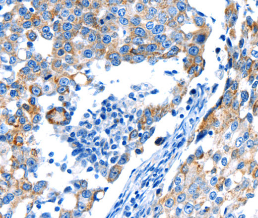 Immunohistochemistry of paraffin-embedded Human breast cancer using POMC Polyclonal Antibody at dilution of 1:30