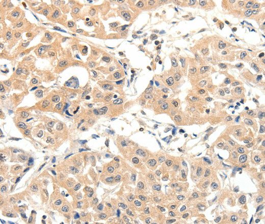 Immunohistochemistry of paraffin-embedded Human lung cancer tissue using SLC27A1 Polyclonal Antibody at dilution 1:40