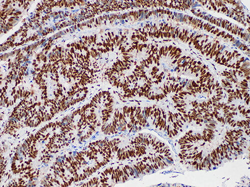 Immunohistochemistry of paraffinembedded Human colon cancer tissue with MutL Protein Homolog 1(MLH1) Monoclonal Antibody(Antigen repaired by EDTA).